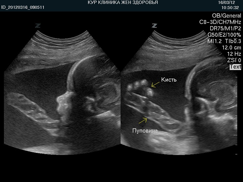 Петли пуповины в области. Обвитие пуповиной на УЗИ 32 недели беременности. Снимки УЗИ.